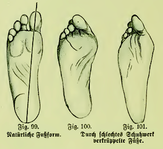 Вальгусная деформация первого пальца стопы